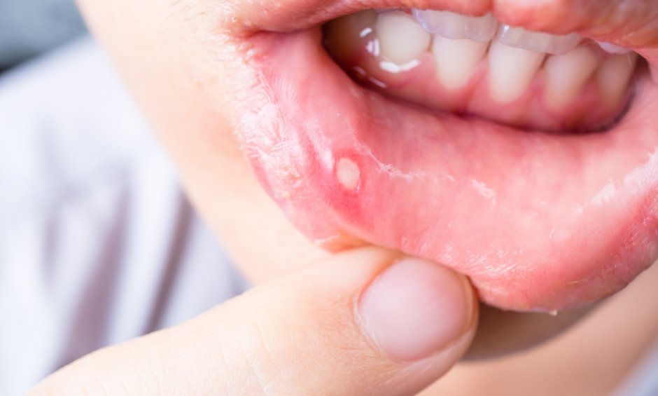 Πως να αντιμετωπίσετε τις άφθες στο στόμα