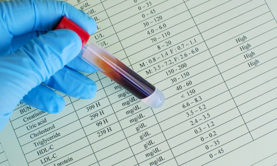 Δεν είναι απαραίτητη η πολύωρη νηστεία για τη διενέργεια εξέτασης χοληστερόλης