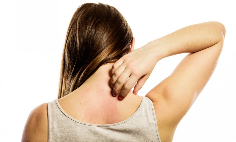 Παγκόσμια Ημέρα Κνίδωσης: Τι πρέπει να ξέρουμε για τις «καντήλες»