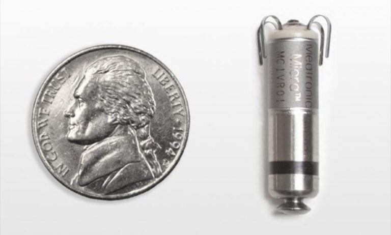 Ο πρώτος ασύρματος βηματοδότης στη Β. Ελλάδα εμφυτεύθηκε στο Διαβαλκανικό!