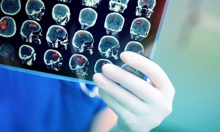 Νέο φάρμακο μειώνει σημαντικά την ατροφία εγκεφάλου σε ασθενείς με Πολλαπλή Σκλήρυνση