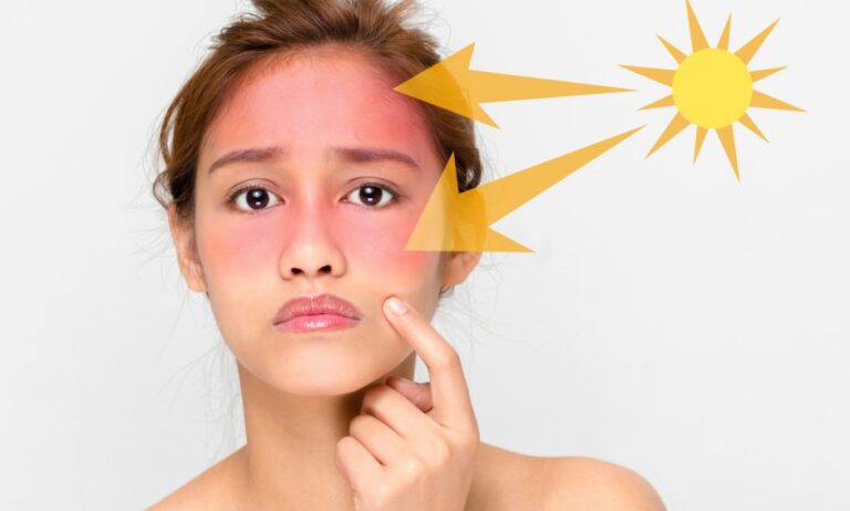 Δερματοπάθειες: οι πιο… ανεπιθύμητοι καλοκαιρινοί επισκέπτες