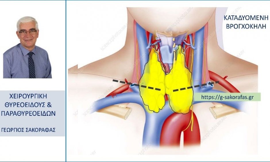 Καταδυόμενη βρογχοκήλη – τι είναι και πώς αντιμετωπίζεται?