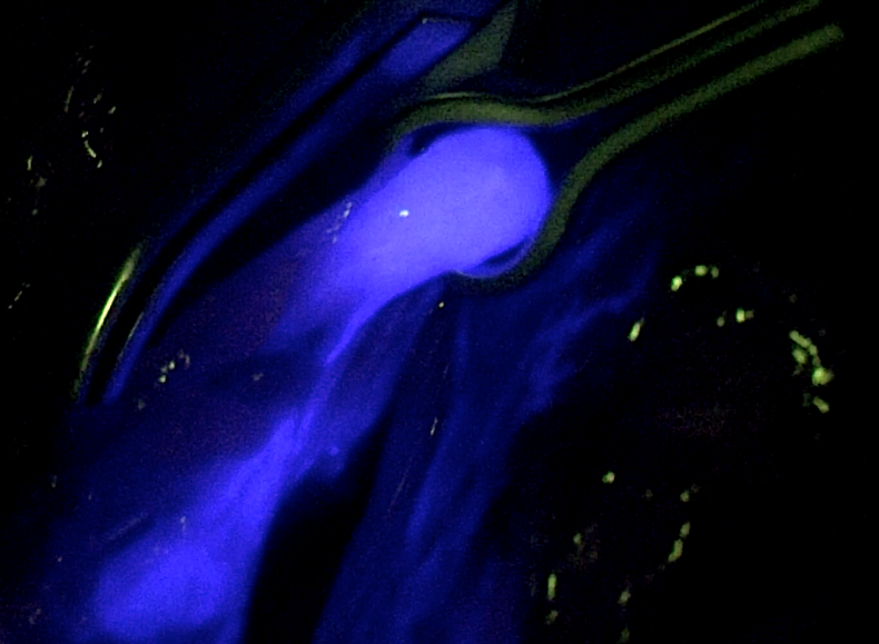 iaso-xeirourgiki-antimetopisi-karkinou-tou-endomitriou-1