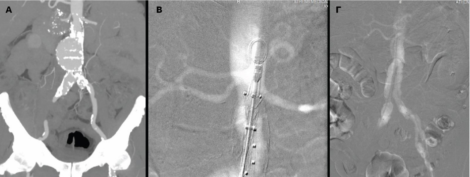 iatriko_kentro_athinon_-_proti_endaggeiaki_apokatastasi_aortikoy_aneyrysmatos_horis_iodioyho_skiagrafiko