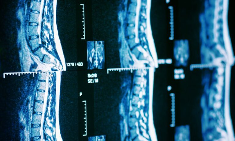 Τα πλεονεκτήματα της Ρομποτική χειρουργικής σπονδυλικής στήλης