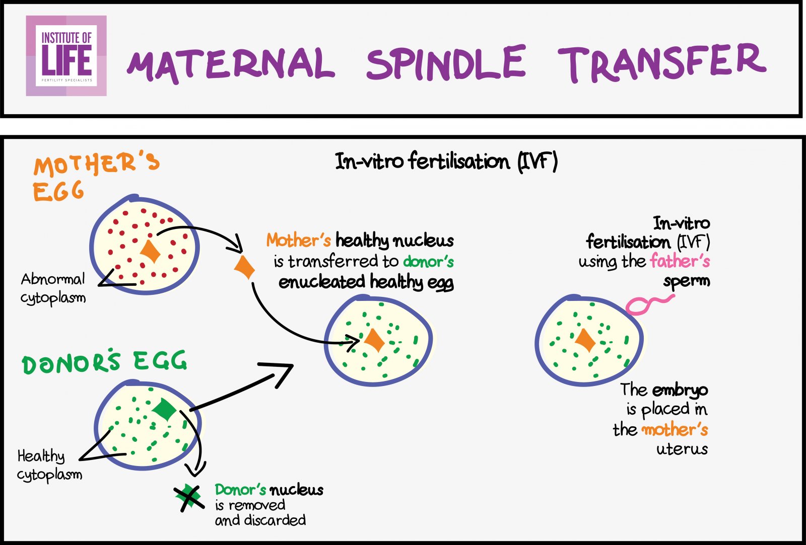 iol_maternalspindletransfer